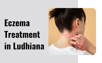 Eczema Treatment in Ludhiana