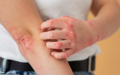 eczema symptoms