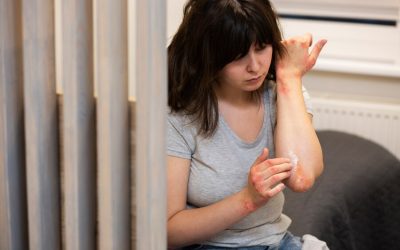 eczema types